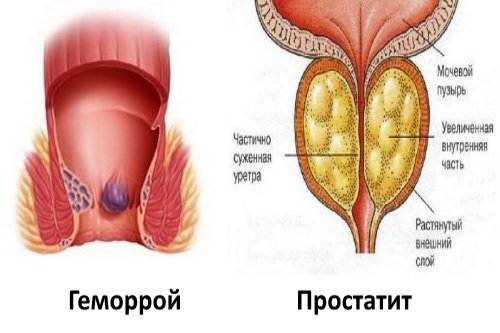 Prostatita de la infecție ,Pidgeum ajută la prostatită